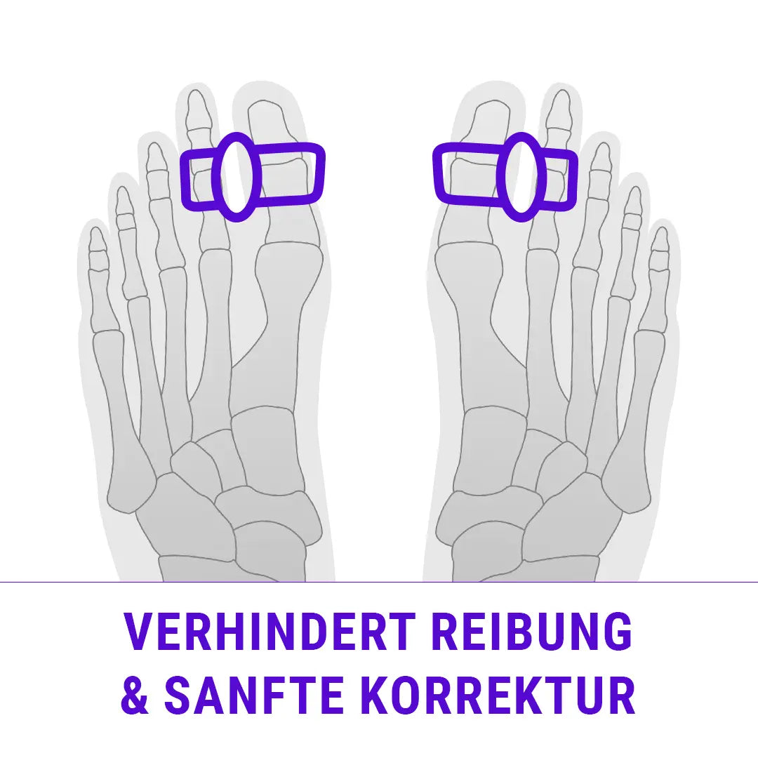 Illustration zur Anwendung des FußGut Gel-Doppelring-Korrektors – Unterstützung bei Hammerzehen und Hallux Valgus.