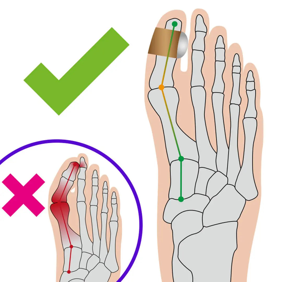 Hallux Softkissen von FußGut – Schaubild der Anwendung. Anatomische Form für optimale Passform und Schutz vor Druckstellen.