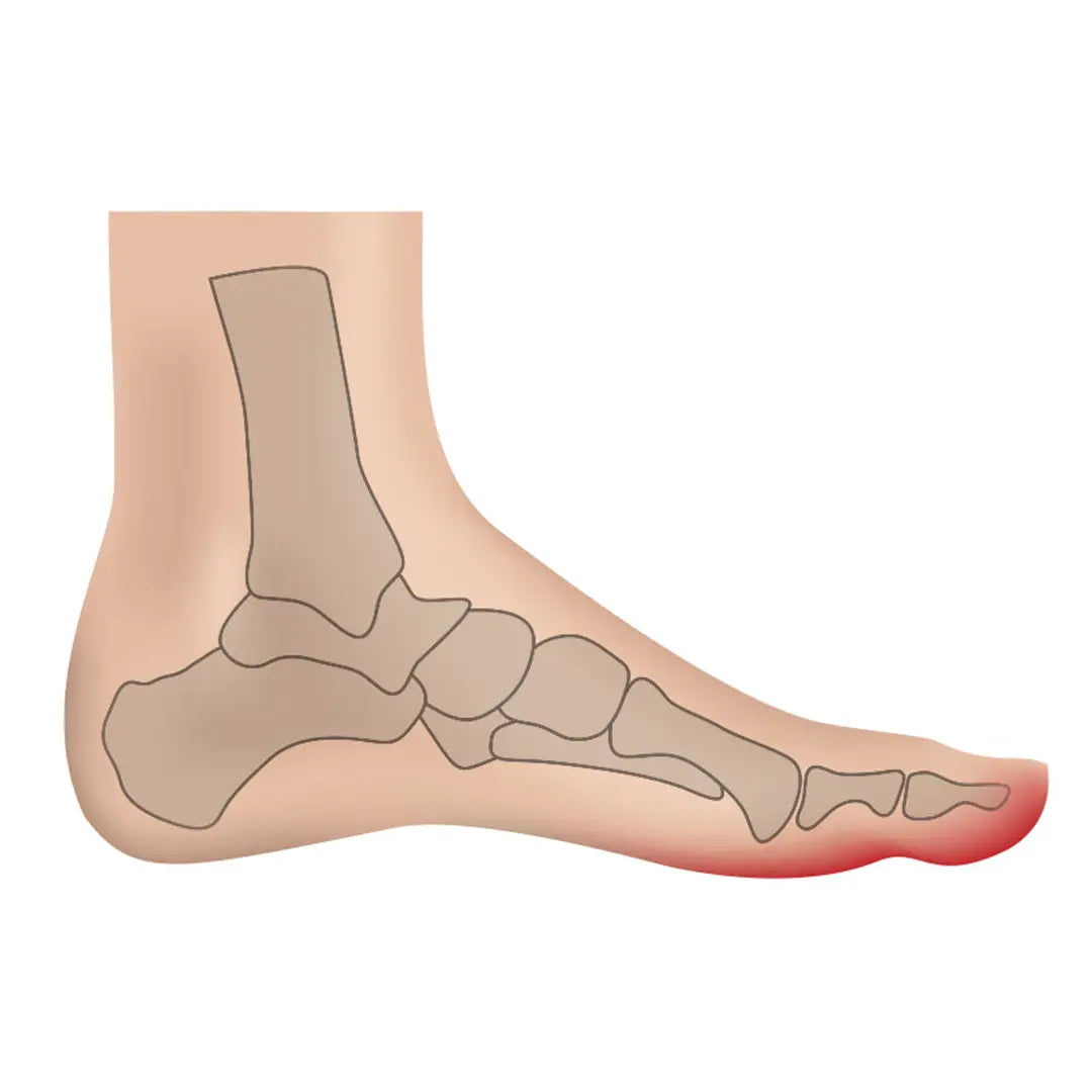 Illustration von Hammerzehen & Druckstellen – Zeigt die anatomische Fehlstellung & betroffene Druckpunkte am Fuß.