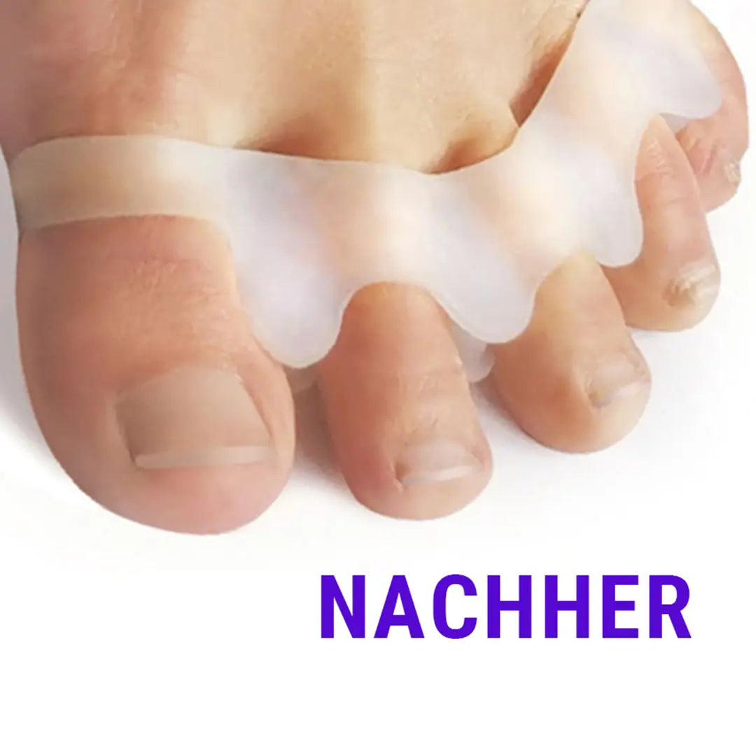 Nachher-Bild mit korrigierter Zehenstellung durch die FußGut Zehen-Distanz-Schiene.